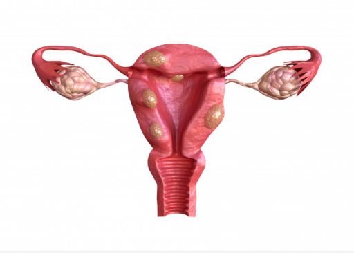 Fibroids and Infertility